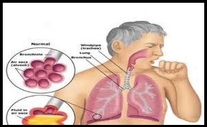 Pneumonia man coughing